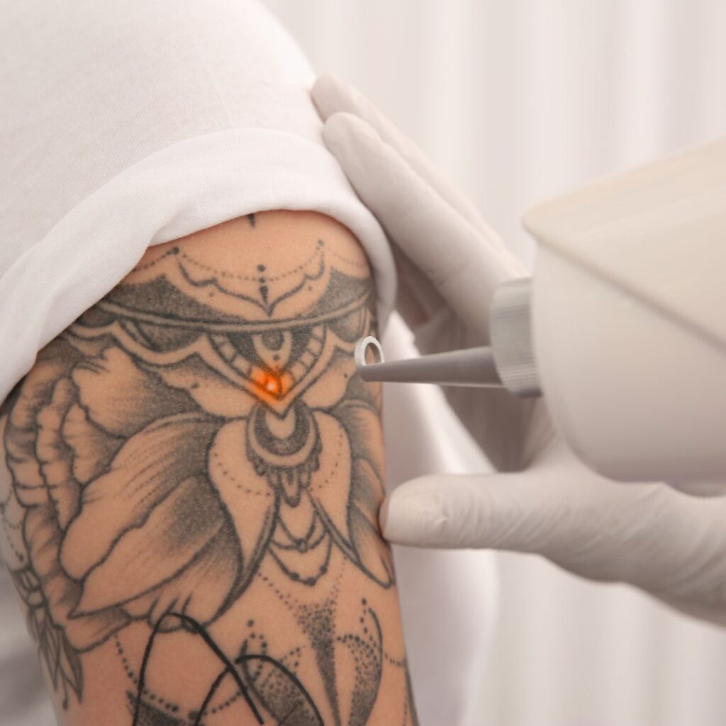 eliminación de tatuajes tenerife