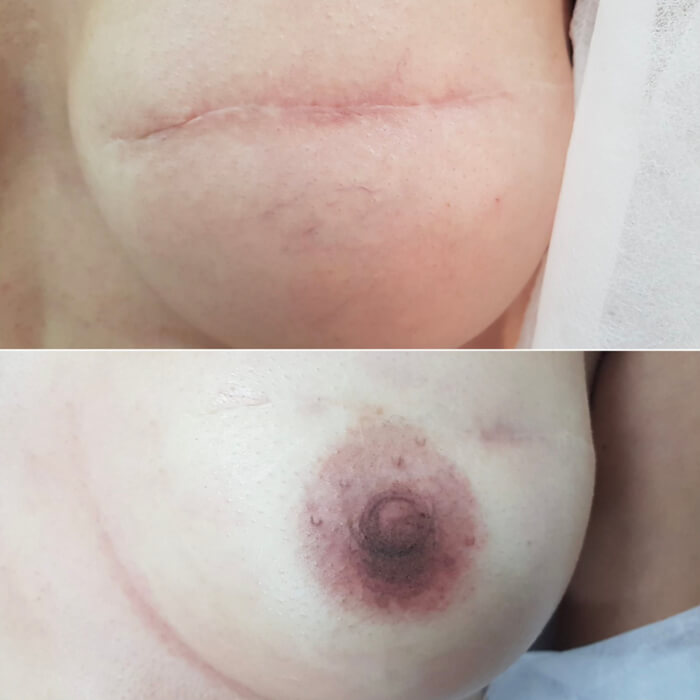 Micropigmentacion areolas tenerife